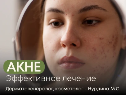 Акне: мифы и реальность